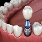 dental implants, tooth replacement, dental implant process, titanium post, dental crown, missing teeth, Haymarket VA dentist, implant care, long-lasting dental implants, bone grafting