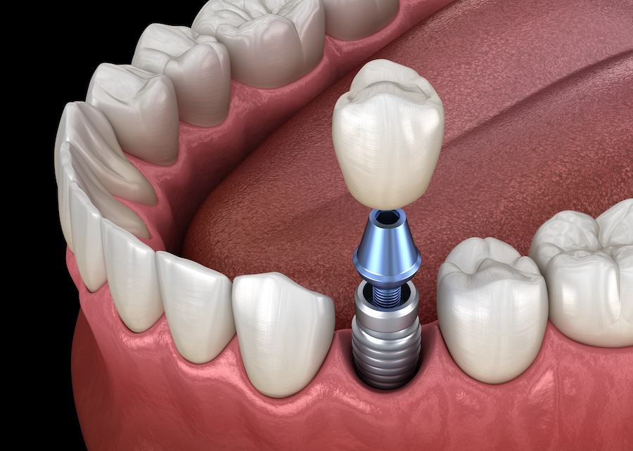 dental implants, tooth replacement, dental implant process, titanium post, dental crown, missing teeth, Haymarket VA dentist, implant care, long-lasting dental implants, bone grafting