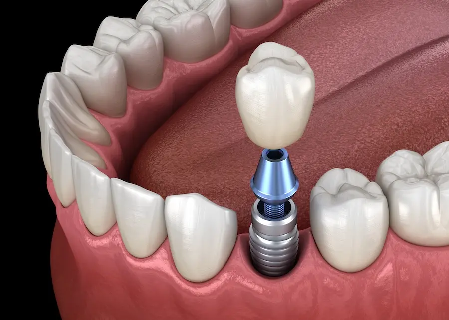 What You Should Know About Dental Implants: A Quick Guide | CIN Dental