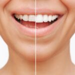 dental veneers before and after and why temporary dental veneers can help