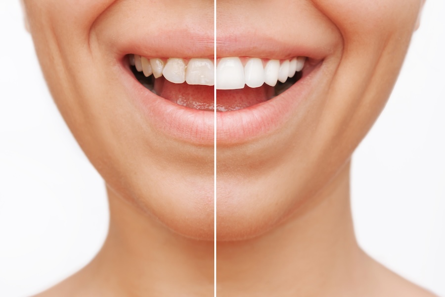 dental veneers before and after and why temporary dental veneers can help