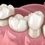 dental crown on mandibular teeth, dental crown options