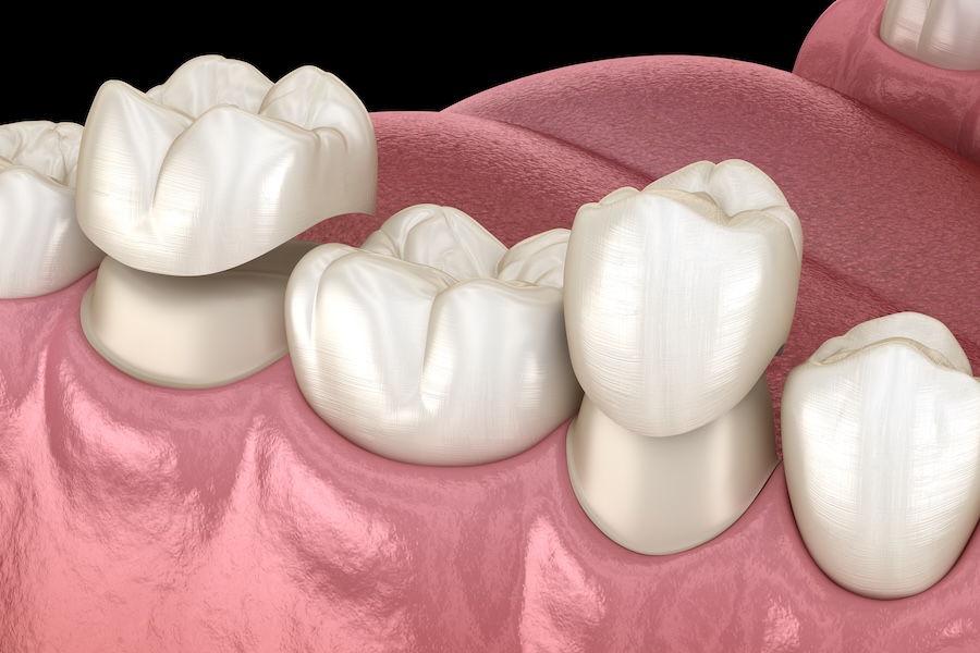 dental crown on mandibular teeth, dental crown options