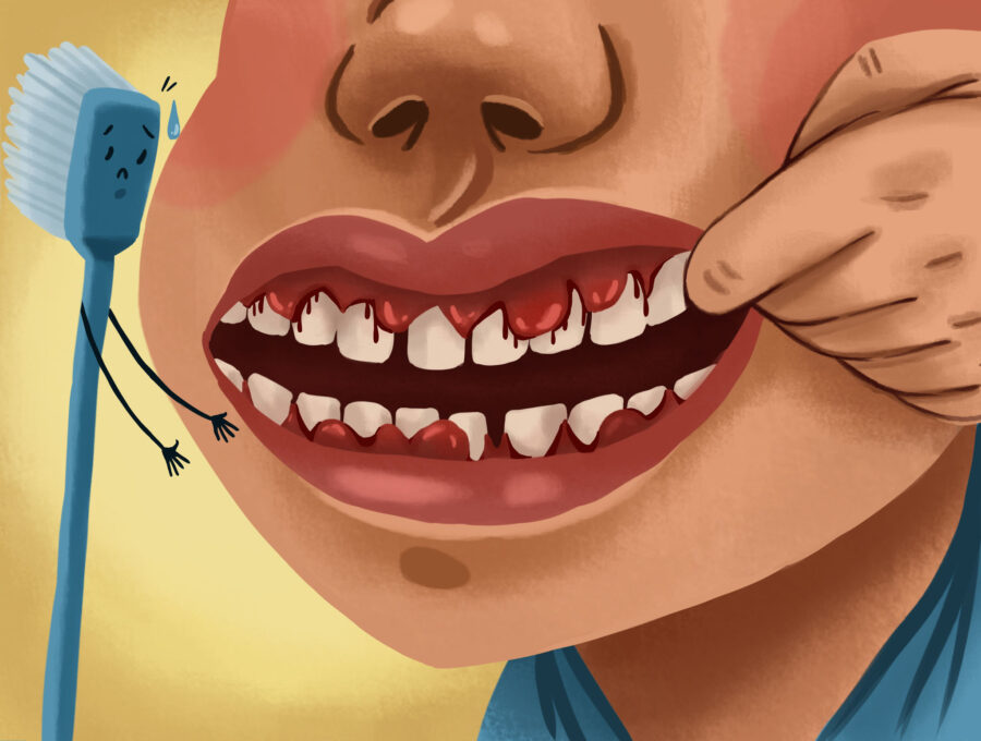 man with bleeding gums, a sign of gum disease or periodontal disease that can be linked to heart health