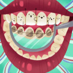 lingual braces, an adult orthodontic option at Cin dental