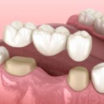 dental bridge dental implants partial denture options for missing tooth replacement